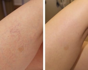 Sclerotherapy Before & After
