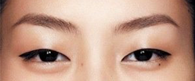 double eyelid