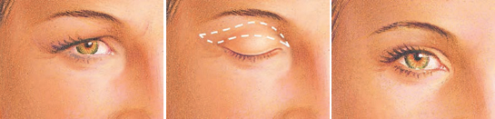 upper eyelid incision