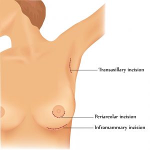 breast augmentation incisions