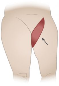 medial thigh lift