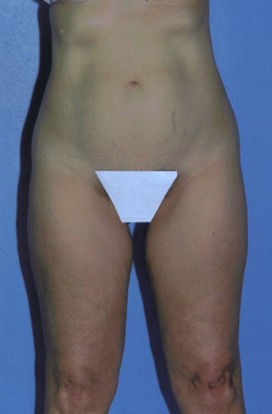Liposuction Before & After Patient #4833