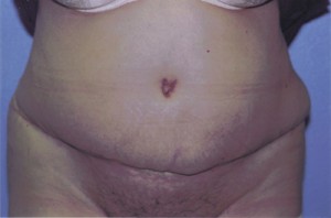 Tummy Tuck Before & After Patient #4850