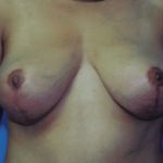 Breast Lift Before & After Patient #5007
