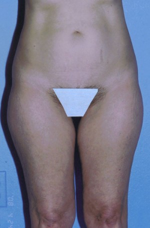 Liposuction Before & After Patient #4833