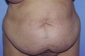 Tummy Tuck Before & After Patient #4850