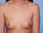 Breast Augmentation Before & After Patient #4909