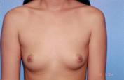 Breast Augmentation Before & After Patient #4909