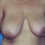 Breast Lift Before & After Patient #5007