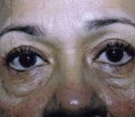 Facelift / Blepharoplasty Before & After Patient #4740