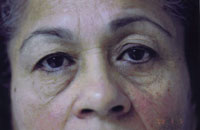 Facelift / Blepharoplasty Before & After Patient #4740