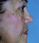 Facelift / Blepharoplasty Before & After Patient #4740