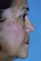 Facelift / Blepharoplasty Before & After Patient #4740