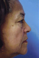 Facelift / Blepharoplasty Before & After Patient #4740