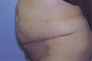 Tummy Tuck Before & After Patient #4850