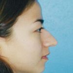 Rhinoplasty Before & After Patient #4786