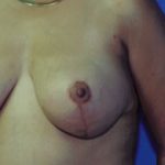 Breast Lift Before & After Patient #5007