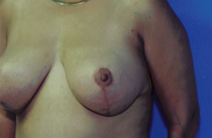 Breast Lift Before & After Patient #5007