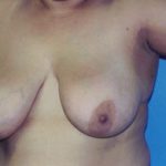 Breast Lift Before & After Patient #5007