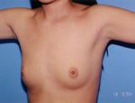 Breast Augmentation Before & After Patient #4909
