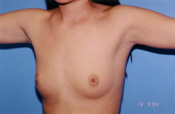 Breast Augmentation Before & After Patient #4909