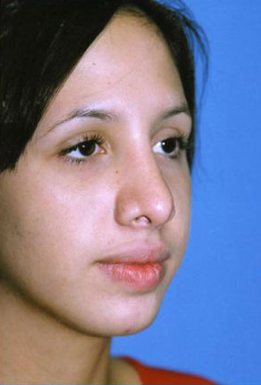 Rhinoplasty Before & After Patient #4789