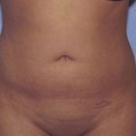 Liposuction Before & After Patient #4836