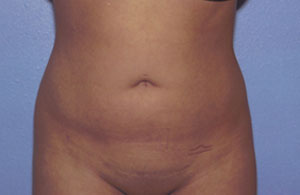 Liposuction Before & After Patient #4836