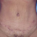 Tummy Tuck Before & After Patient #4855