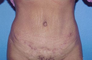 Tummy Tuck Before & After Patient #4855