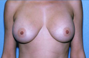 Breast Augmentation Before & After Patient #4916