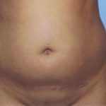 Liposuction Before & After Patient #4836