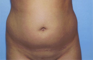 Liposuction Before & After Patient #4836