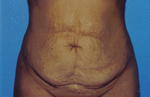 Tummy Tuck Before & After Patient #4855