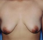 Breast Lift Before & After Patient #5014