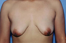 Breast Lift Before & After Patient #5014