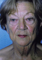 Facelift / Blepharoplasty Before & After Patient #4750