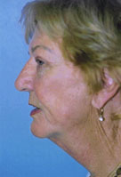 Facelift / Blepharoplasty Before & After Patient #4750