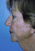 Facelift / Blepharoplasty Before & After Patient #4750