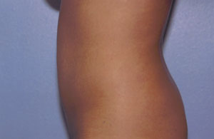 Liposuction Before & After Patient #4836