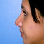 Rhinoplasty Before & After Patient #4789