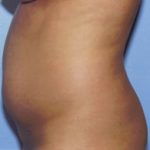 Liposuction Before & After Patient #4836