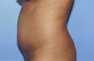 Liposuction Before & After Patient #4836