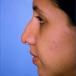 Rhinoplasty Before & After Patient #4789