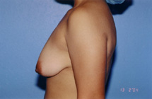 Breast Lift Before & After Patient #5014