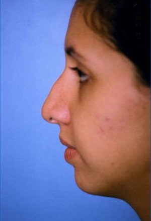 Rhinoplasty Before & After Patient #4789