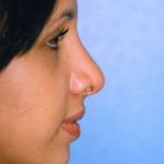 Rhinoplasty Before & After Patient #4789