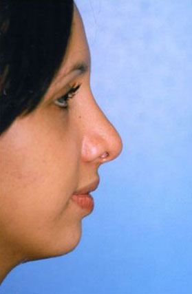 Rhinoplasty Before & After Patient #4789