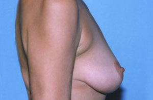 Breast Augmentation Before & After Patient #4916