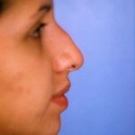 Rhinoplasty Before & After Patient #4789